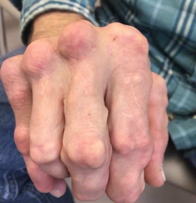 Danh sách đen 6 thực phẩm là "đồng phạm" của bệnh gout nhưng nhiều người ăn vô tội vạ danh sach den 6 thuc pham la dong pham cua benh gout nhung nhieu nguoi an vo toi va