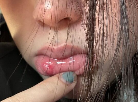 5 thay đổi ở môi đang CHỈ ĐIỂM ung thư dù nhiều người "không thèm để ý" 5 thay doi o moi dang chi diem ung thu du nhieu nguoi khong them de y