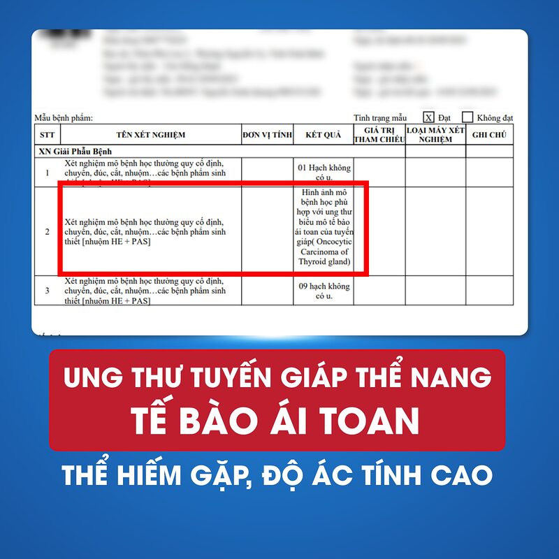 Bé trai 13 tuổi mắc ung thư tuyến giáp, phát triển nhanh chỉ trong vài tuần 1 Bé trai 13 tuổi mắc ung thư tuyến giáp, phát triển nhanh chỉ trong vài tuần