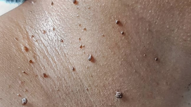 Người có 4 thứ này trên da dễ có "cả đống" tế bào ung thư trong người mà chưa biết 1 Người có 4 thứ này trên da dễ có "cả đống" tế bào ung thư trong người mà chưa biết