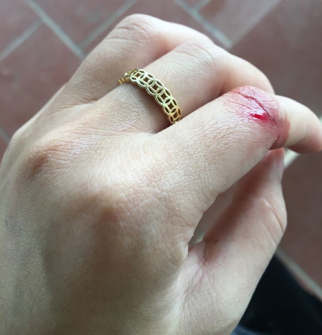 6 bất thường ở bàn tay đang ám chỉ lượng đường trong máu vượt ngưỡng an toàn, tiếc là rất ít người để ý! 3 6 bất thường ở bàn tay đang ám chỉ lượng đường trong máu vượt ngưỡng an toàn, tiếc là rất ít người để ý! 6 bat thuong o ban tay dang am chi luong duong trong mau vuot nguong an toan tiec la rat it nguoi de y