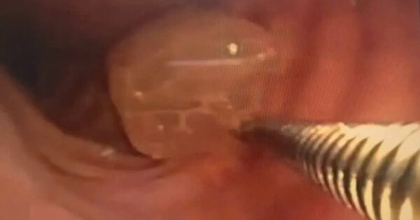 Nguy kịch vì nửa quả nho mắc kẹt ở phế quản