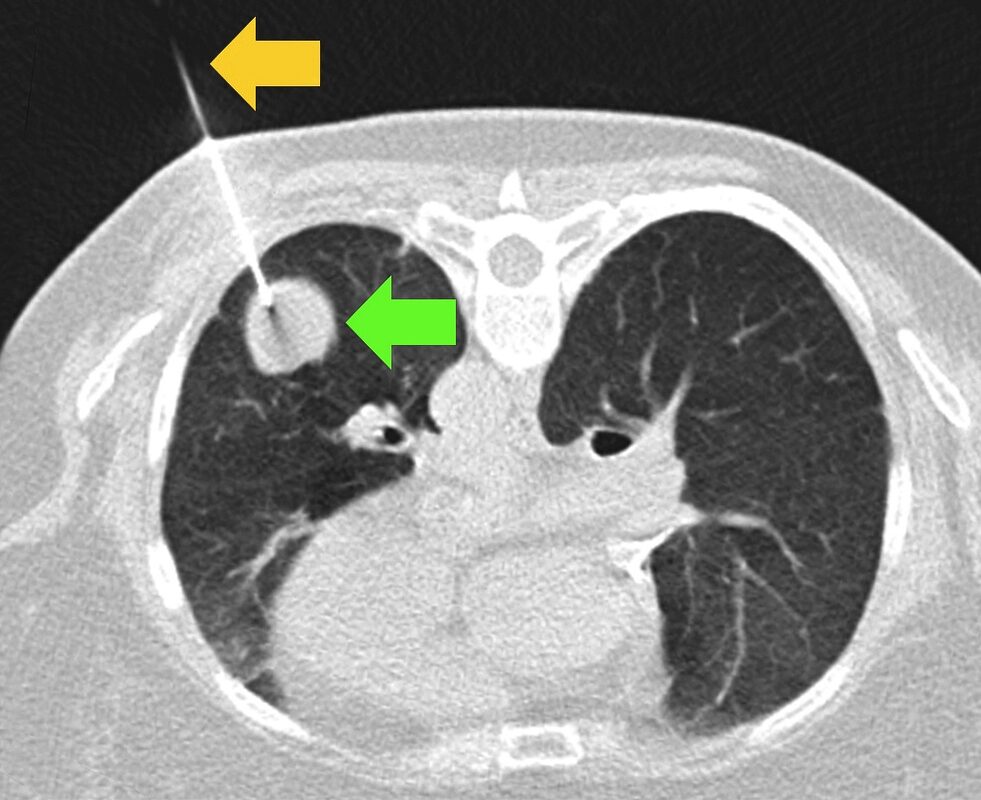 5 vị trí trên cơ thể mà tế bào ung thư "ĐẶC BIỆT YÊU THÍCH", đáng sợ là khám sức khỏe định kỳ vẫn dễ lọt khối u 5 vi tri tren co the ma te bao ung thu dac biet yeu thich dang so la kham suc khoe dinh ky van de lot khoi u