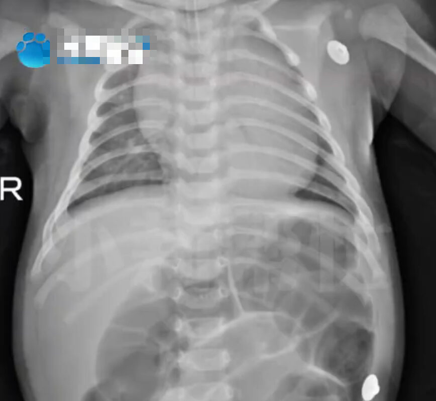 Em bé 52 ngày tuổi ngộ độc Botulinum nguy kịch vì loại nước chữa ho, bổ phổi rất quen từ bà ngoại em be 52 ngay tuoi ngo doc botulinum nguy kich vi loai nuoc chua ho bo phoi rat quen tu ba ngoai