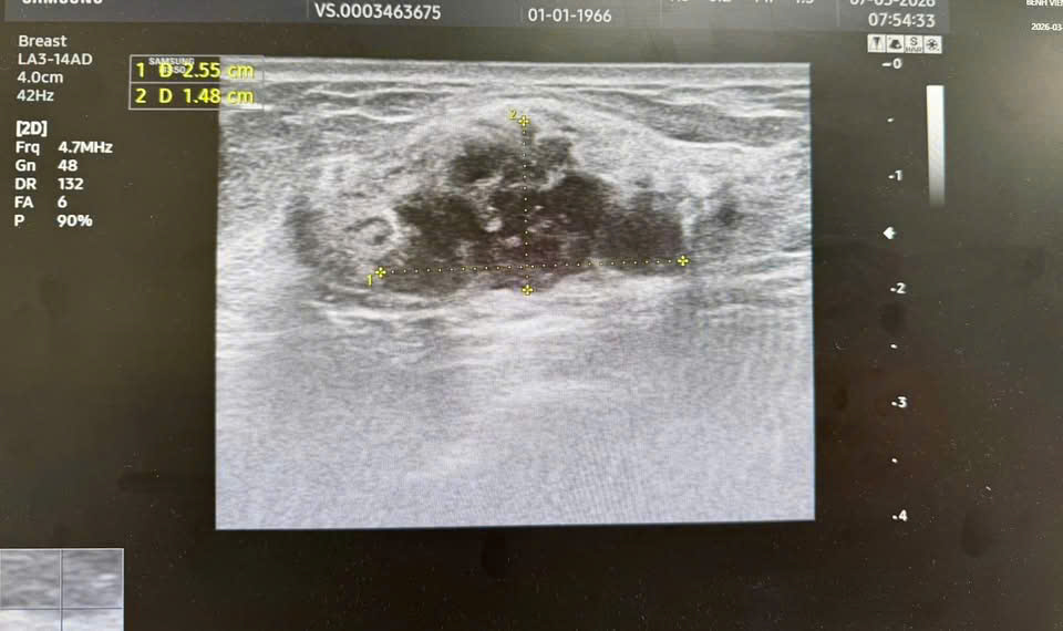 Phát hiện ung thư khi vẫn “khỏe mạnh”: Bác sĩ ung bướu cảnh báo sai lầm nhiều người mắc phải 4 Phát hiện ung thư khi vẫn “khỏe mạnh”: Bác sĩ ung bướu cảnh báo sai lầm nhiều người mắc phải phat hien ung thu khi van khoe manh bac si ung buou canh bao sai lam nhieu nguoi mac phai