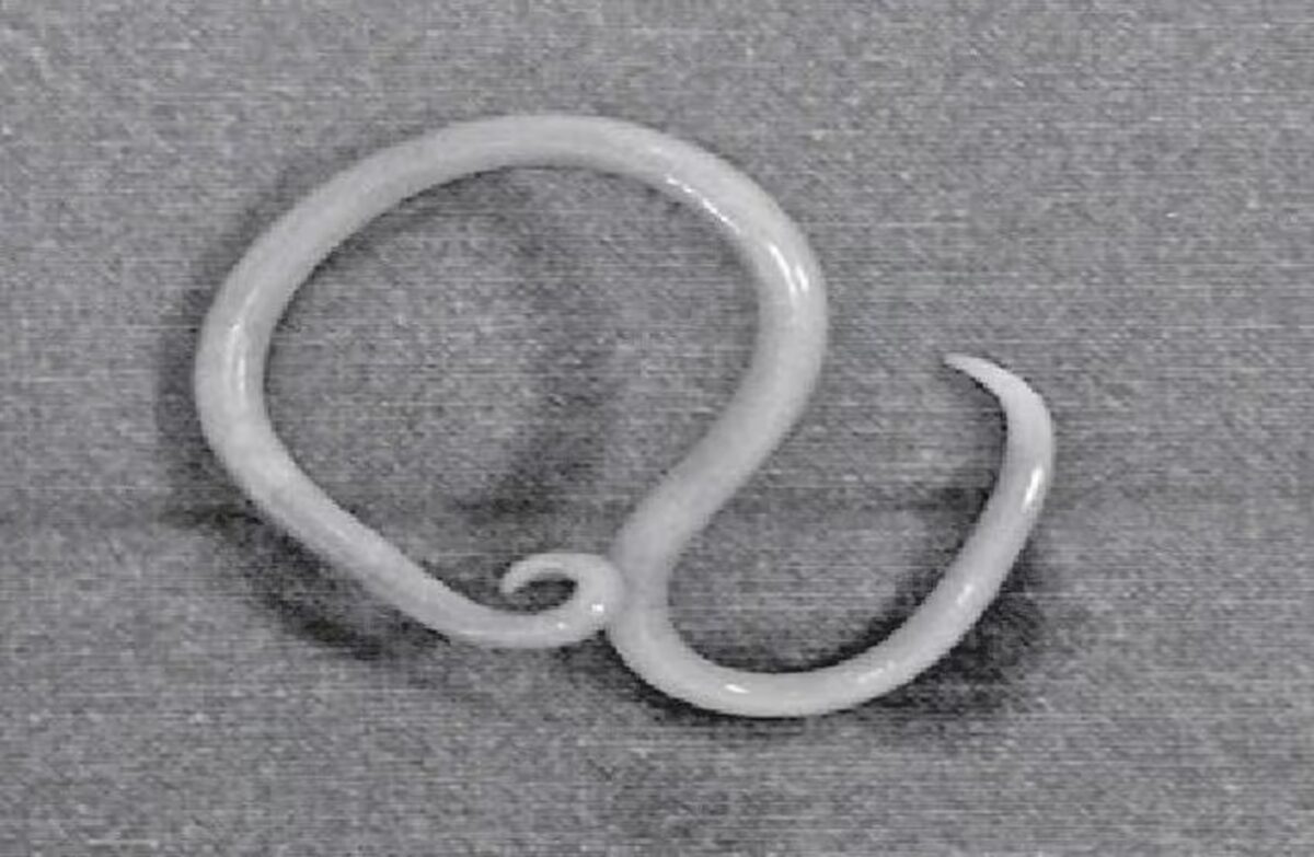 Thiếu niên 15 tuổi bị đau bụng thúc ngược lên, bác sĩ phát hiện "bí mật" đáng sợ bên trong thieu nien 15 tuoi bi dau bung thuc nguoc len bac si phat hien bi mat dang so ben trong